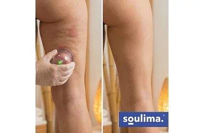 Set de cupe chinezești pentru ventuze fără foc – 12 bucăți